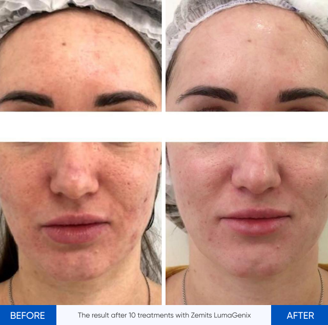 Zemits LumaGenix PDT Propesyonal na LED na Aparato para sa Paggamot ng Liwanag