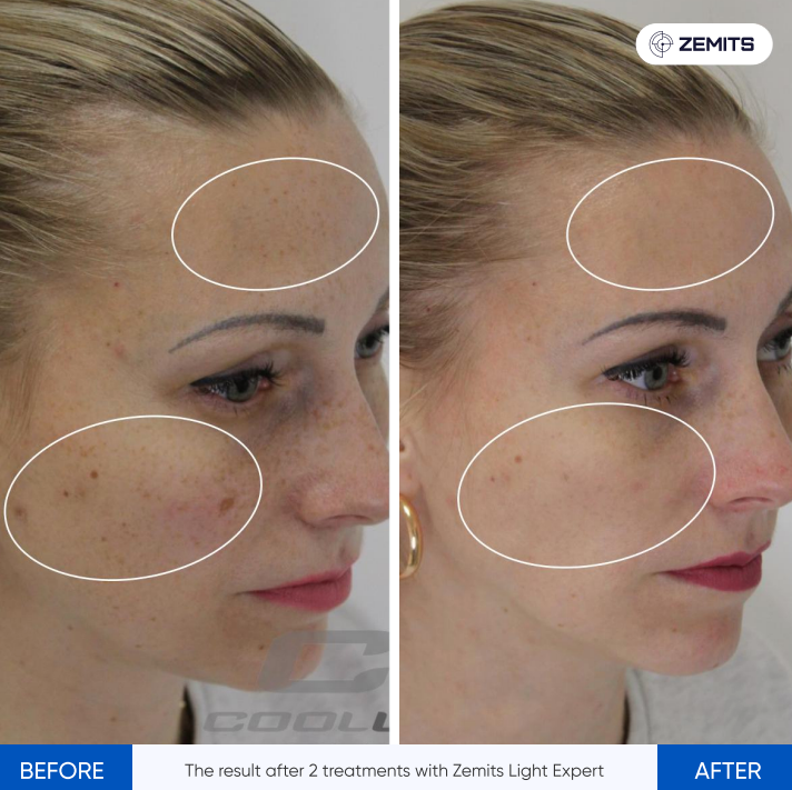 Zemits Light Expert 2.0 IPL Laser na Makina