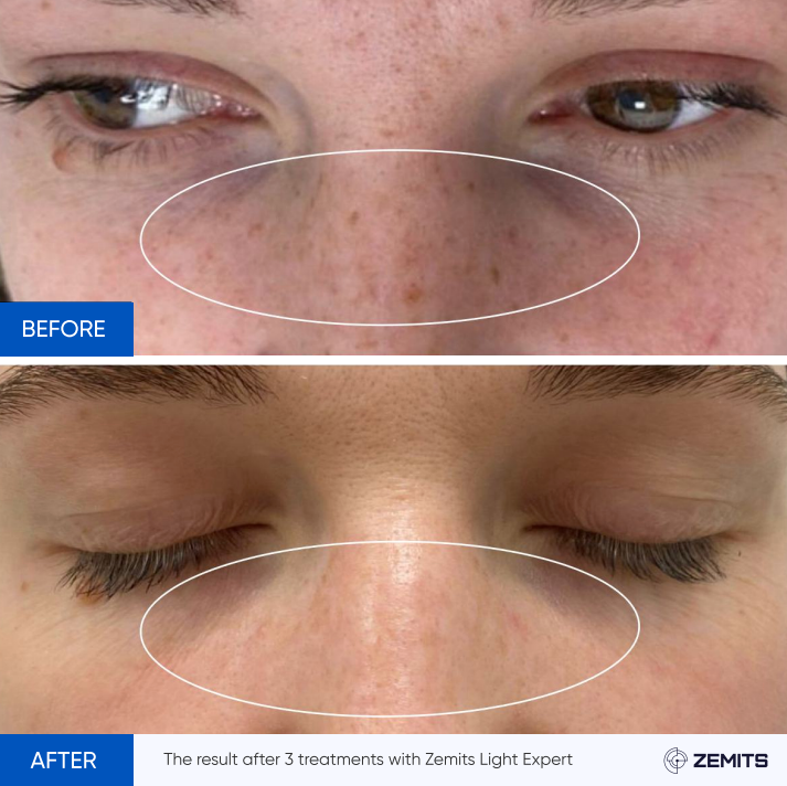 Zemits Light Expert 2.0 IPL Laser na Makina