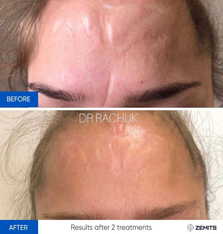 Zemits CarbonFrax Pro: CO2 Praksiyonal na Laser