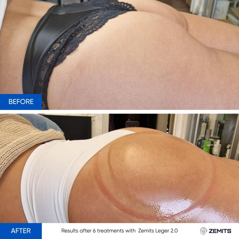 Zemits Leger 2.0 Sistema ng Vacuum Cupping na may XXL na mga Tasa sa Set
