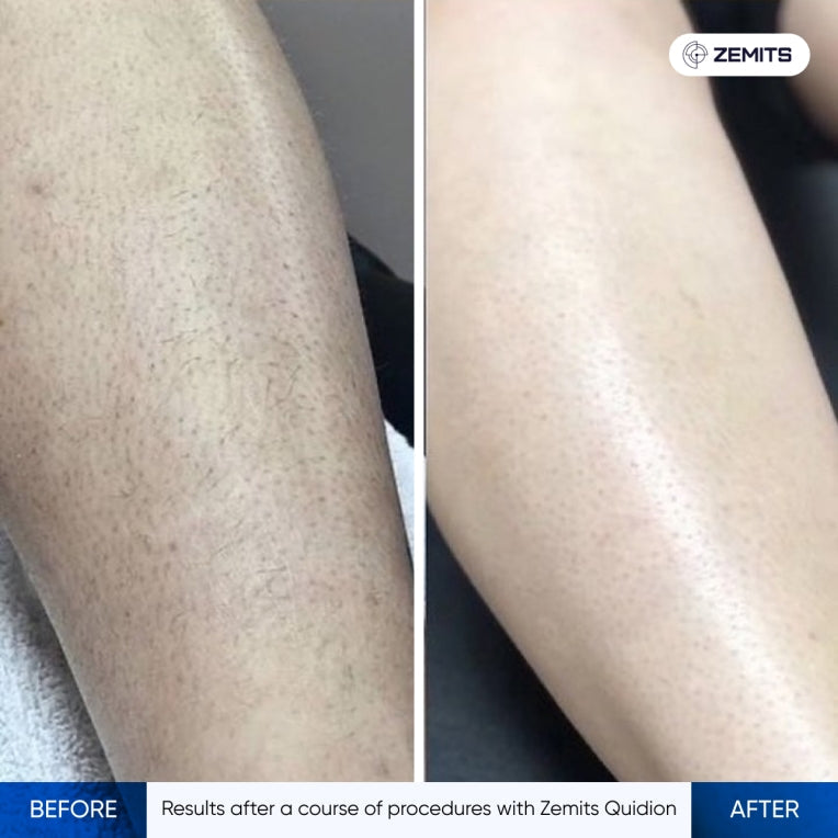 Zemits Quidion Diode Laser Para sa Pag-aalis ng Buhok