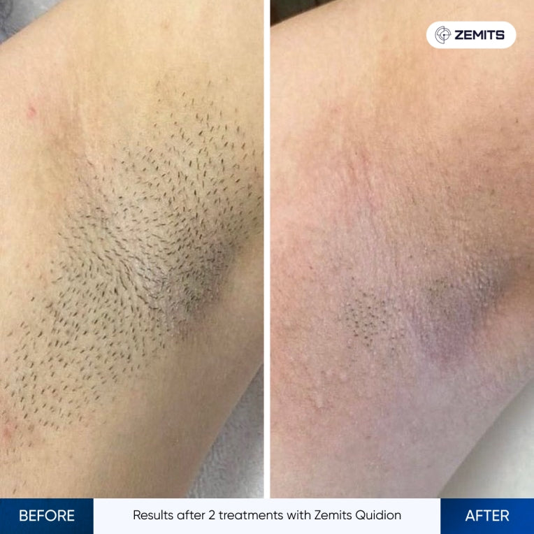Zemits Quidion Diode Laser Para sa Pag-aalis ng Buhok