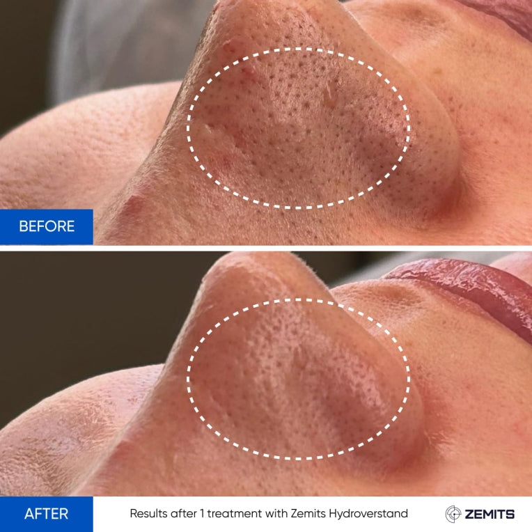Zemits HydroVerstand PRO 7-in-1 HydroDiamond™ Sistema